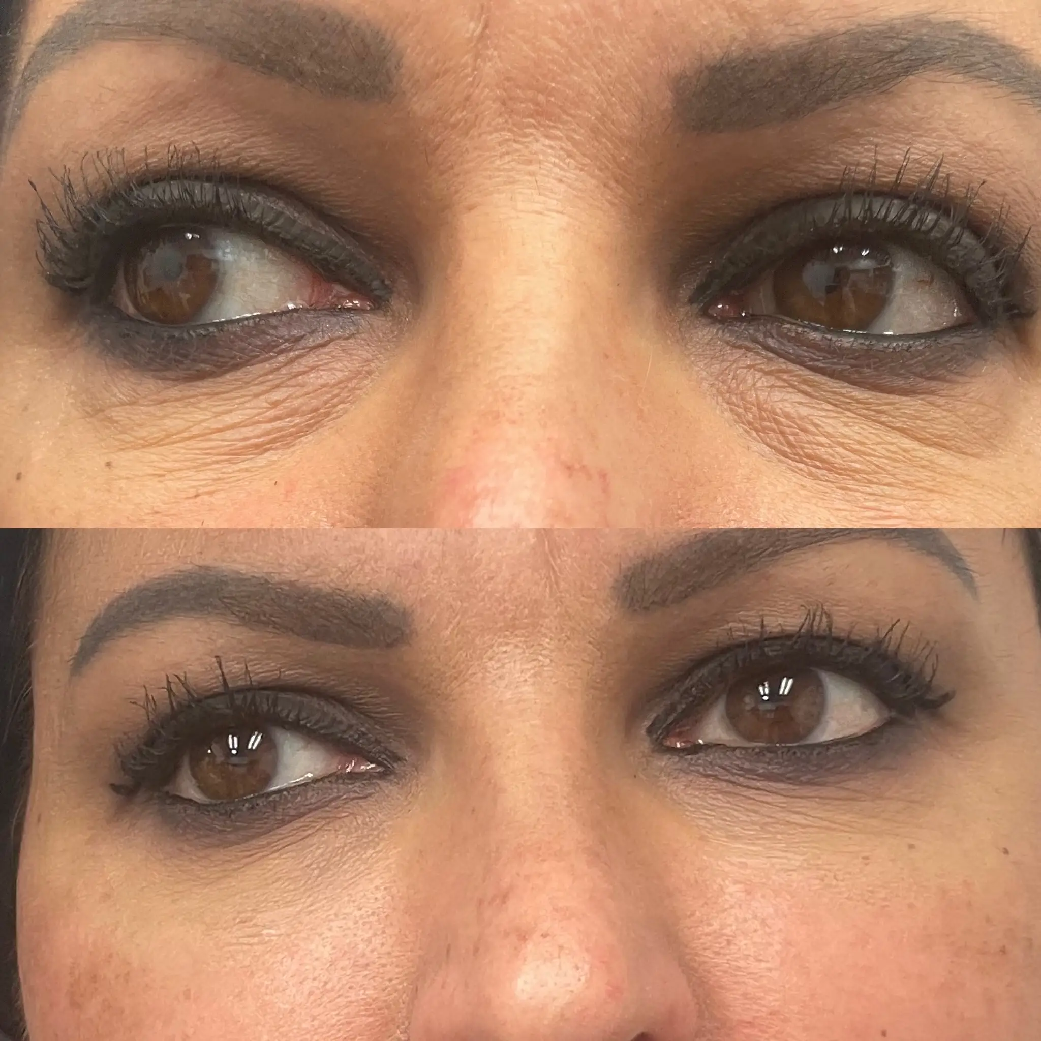 Before After d | Pink Opal Aesthetics | San Mateo, CA