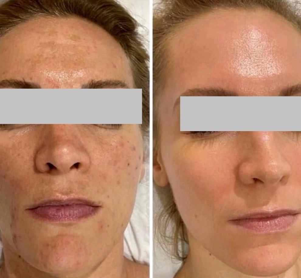 chemical peel Before After A | Pink Opal Aesthetics | San Mateo, CA