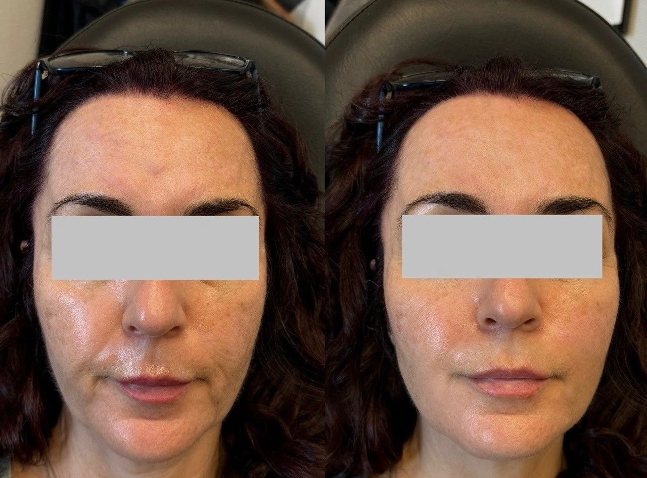 Aesthetics Gallery Transformation | Pink Opal Aesthetics | San Mateo, CA