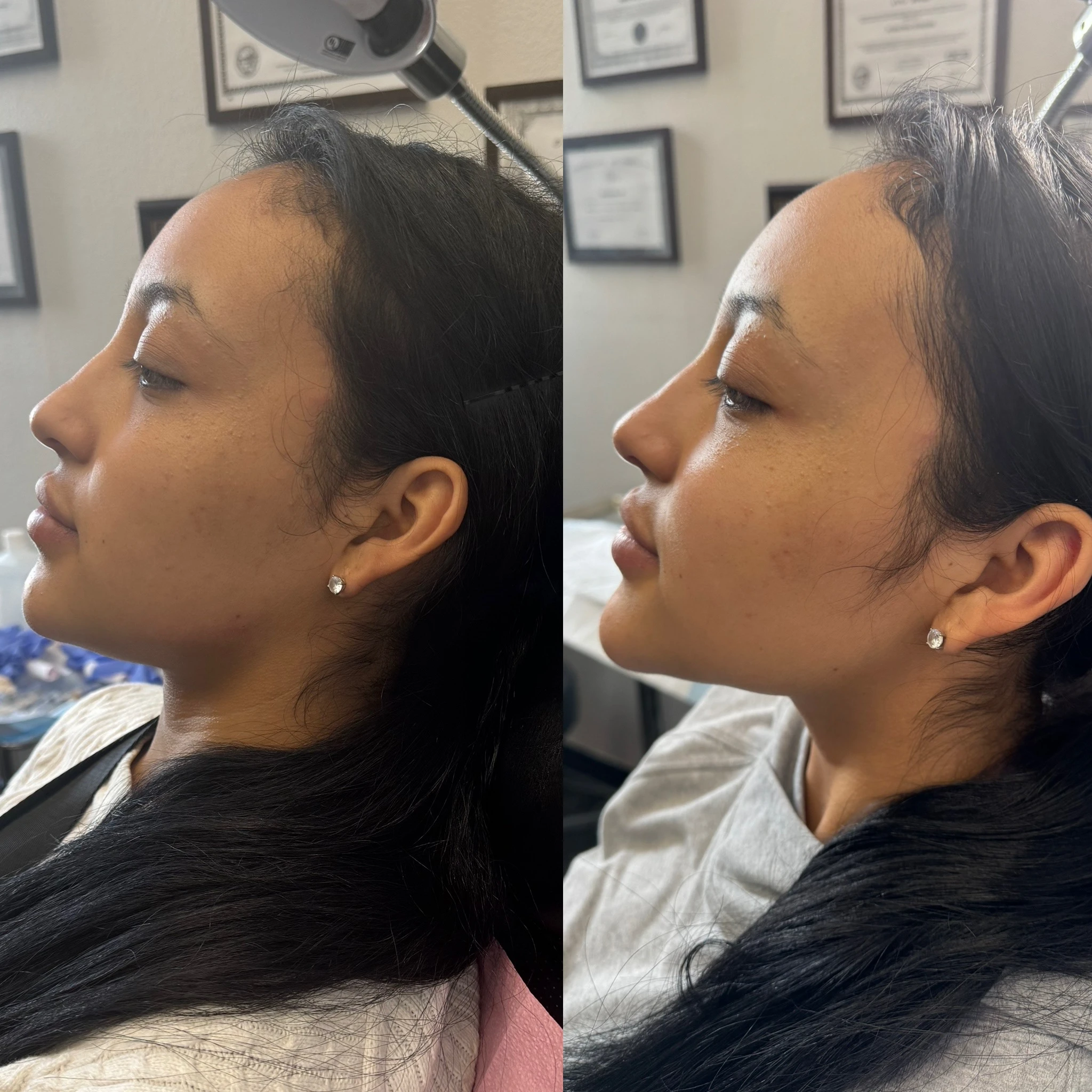 Before and After Chin filler | Pink Opal Aesthetics