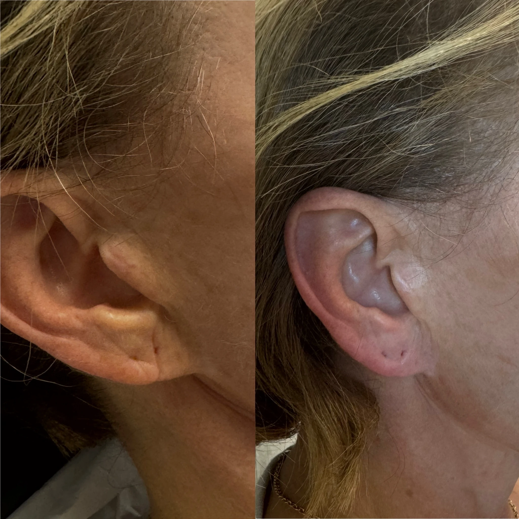 Before and After Earlobe filler2 | Pink Opal Aesthetics
