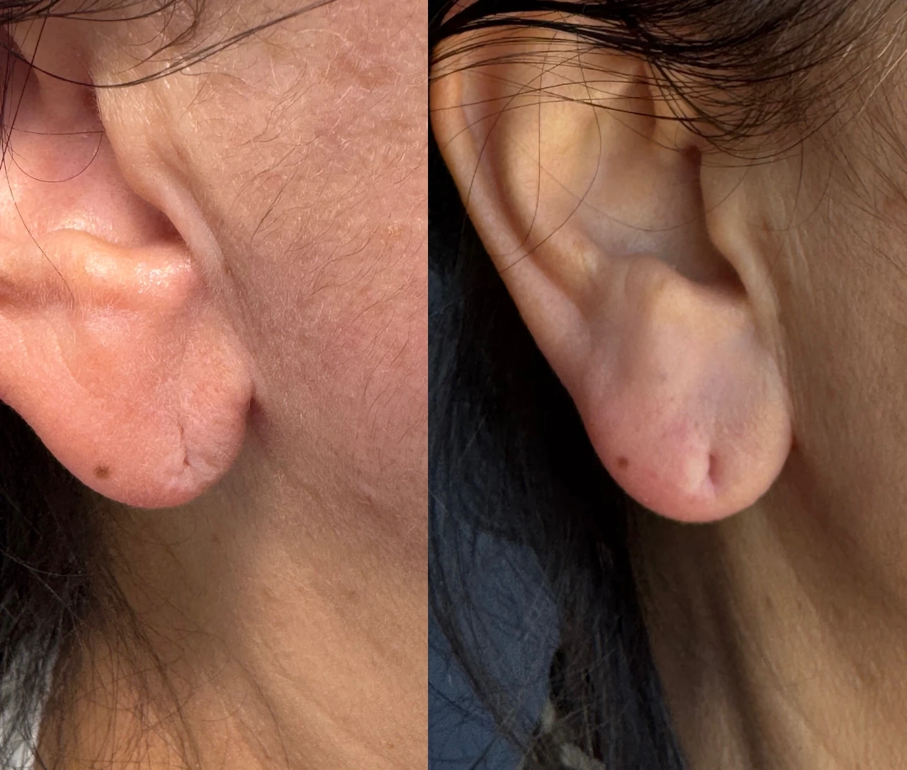 Before and After Earlobe filler | Pink Opal Aesthetics