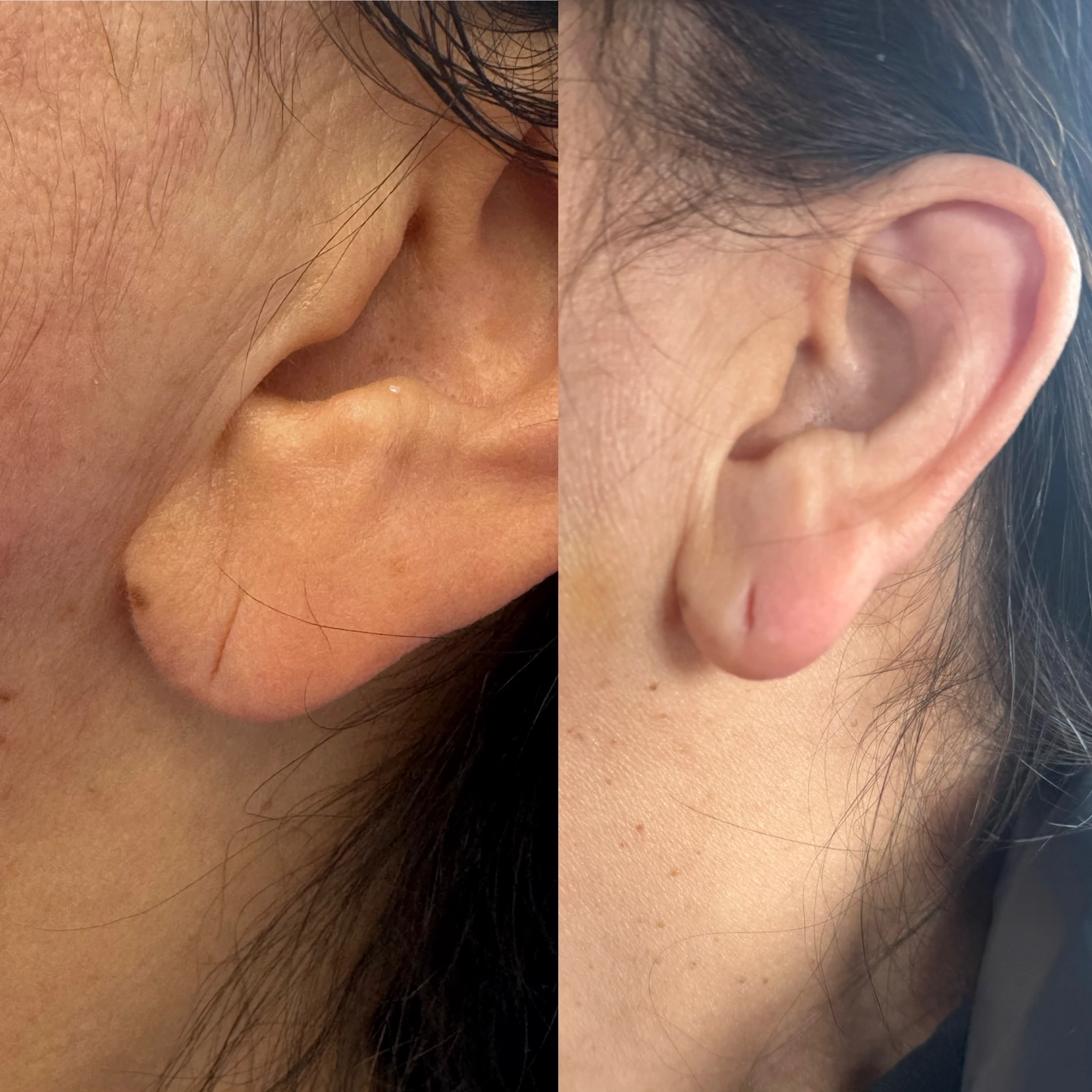 Before and After Earlobe filler1 | Pink Opal Aesthetics