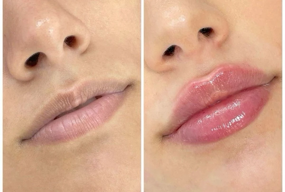 Before and After Lip filler2 | Pink Opal Aesthetics