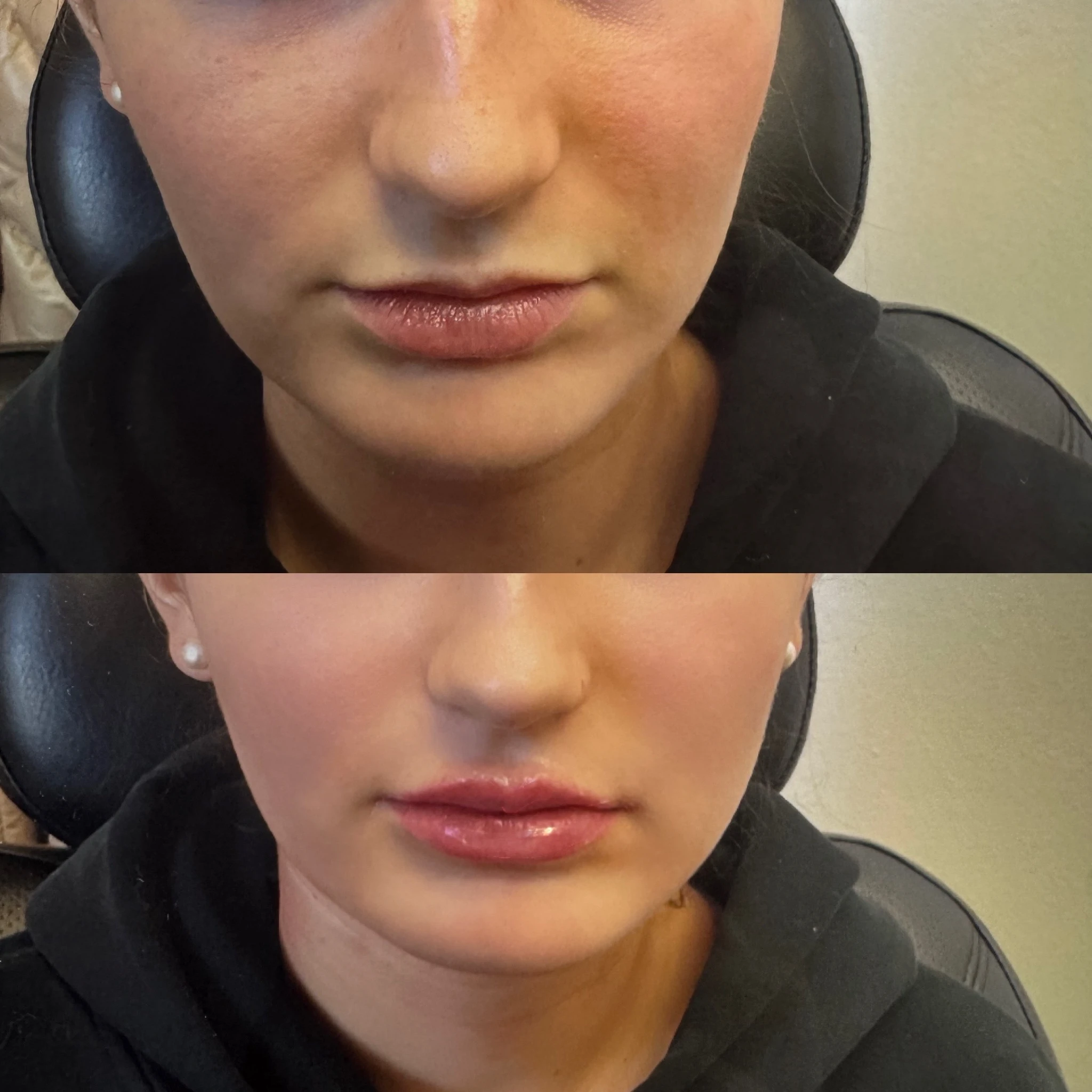Before and After Lip filler | Pink Opal Aesthetics