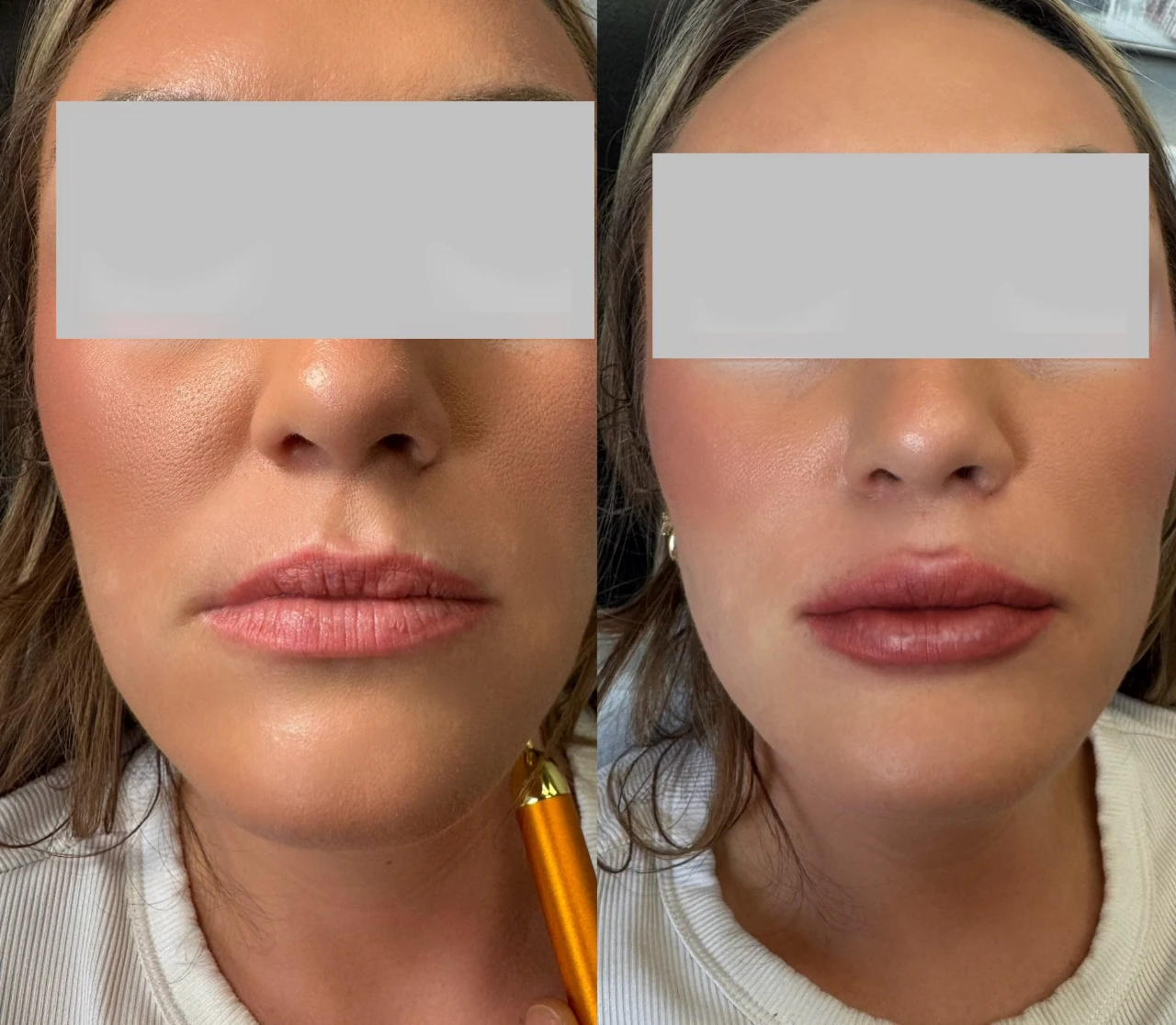 Before and After Lip filler4 | Pink Opal Aesthetics