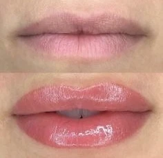 Before and After Lip filler3 | Pink Opal Aesthetics