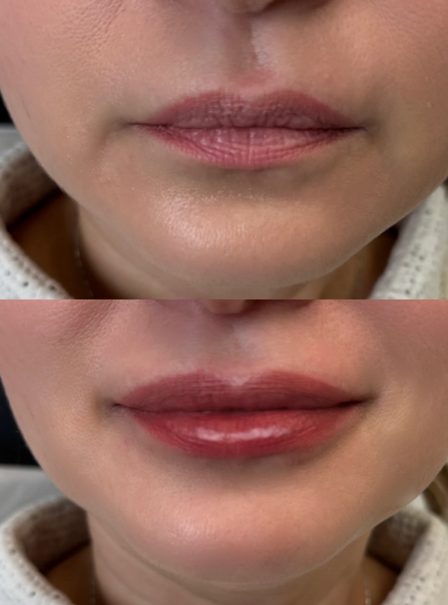 Before and After Lip filler1 | Pink Opal Aesthetics