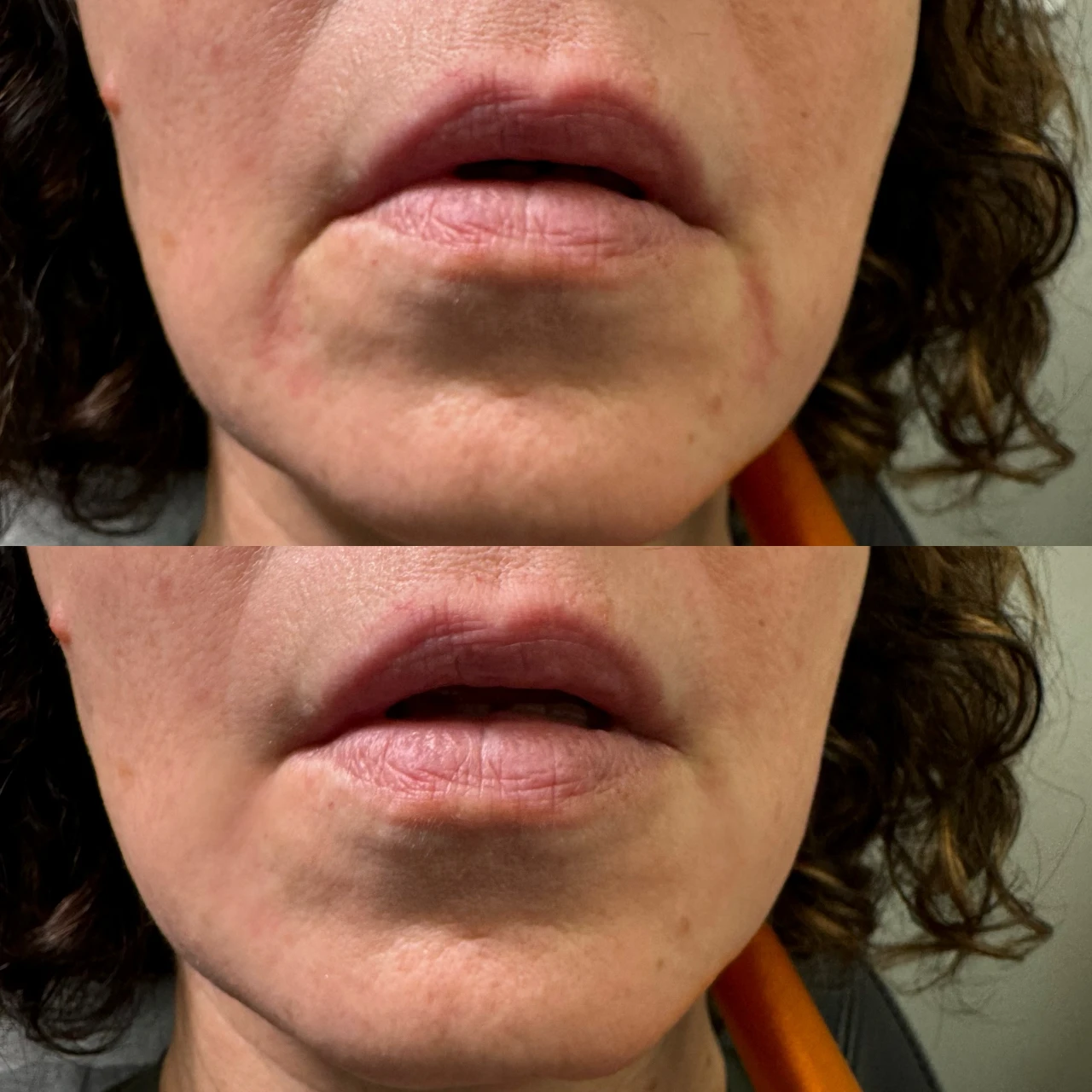 Before And After Marionettes Line | Pink Opal Aesthetics