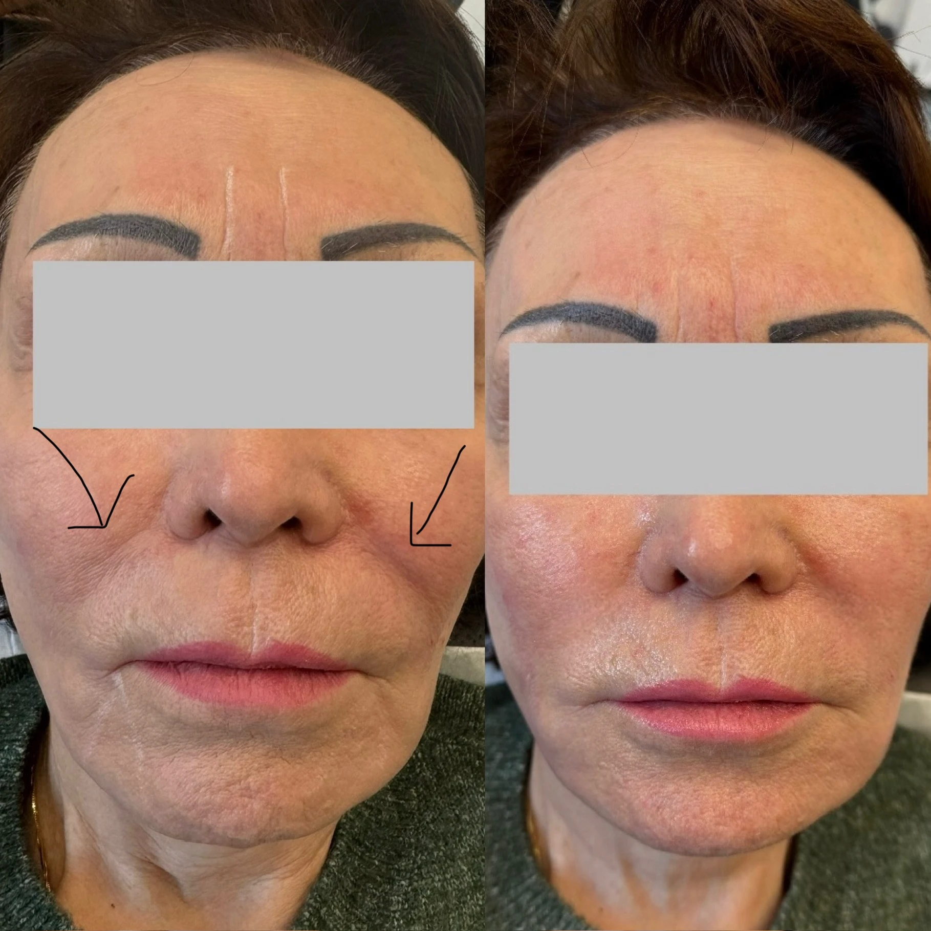 Before And After Marionettes | Pink Opal Aesthetics