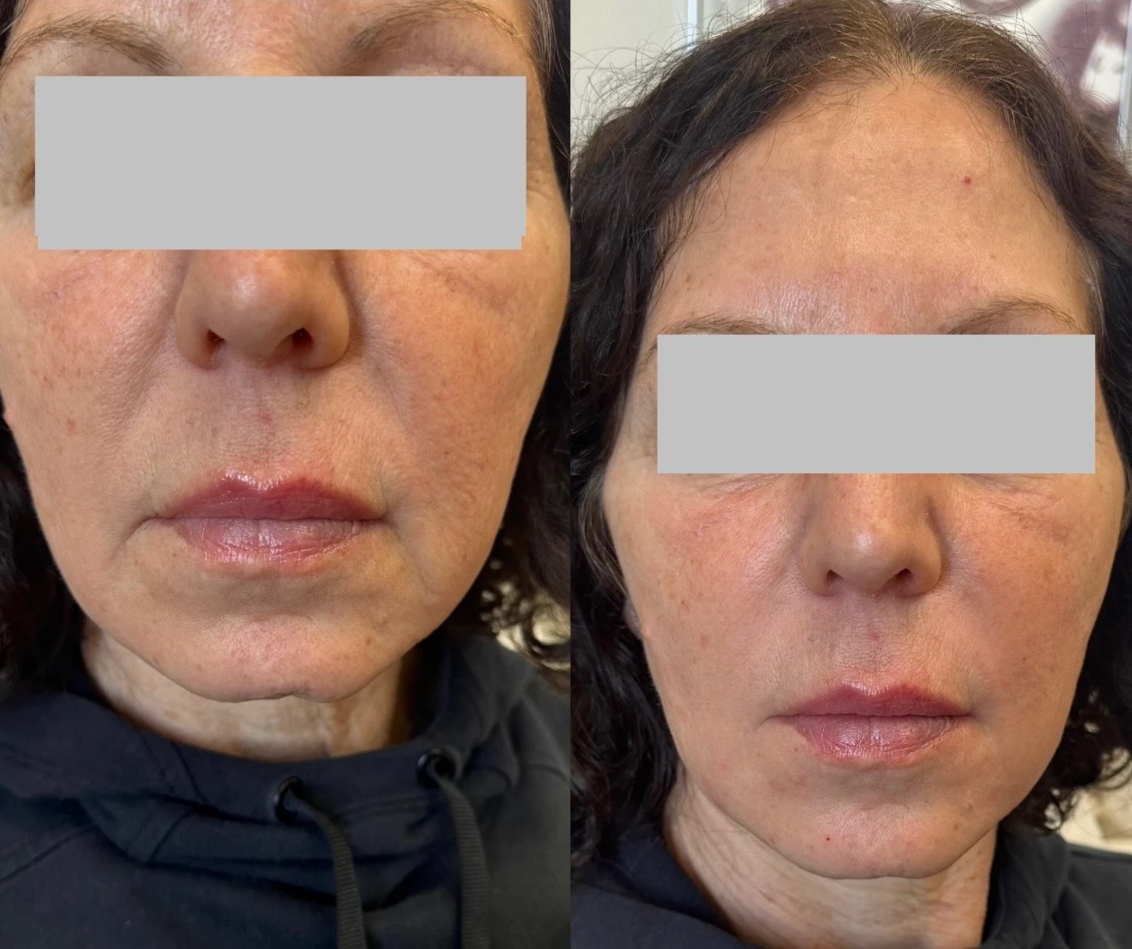 Before And After Smile Lines And Marionettes | Pink Opal Aesthetics