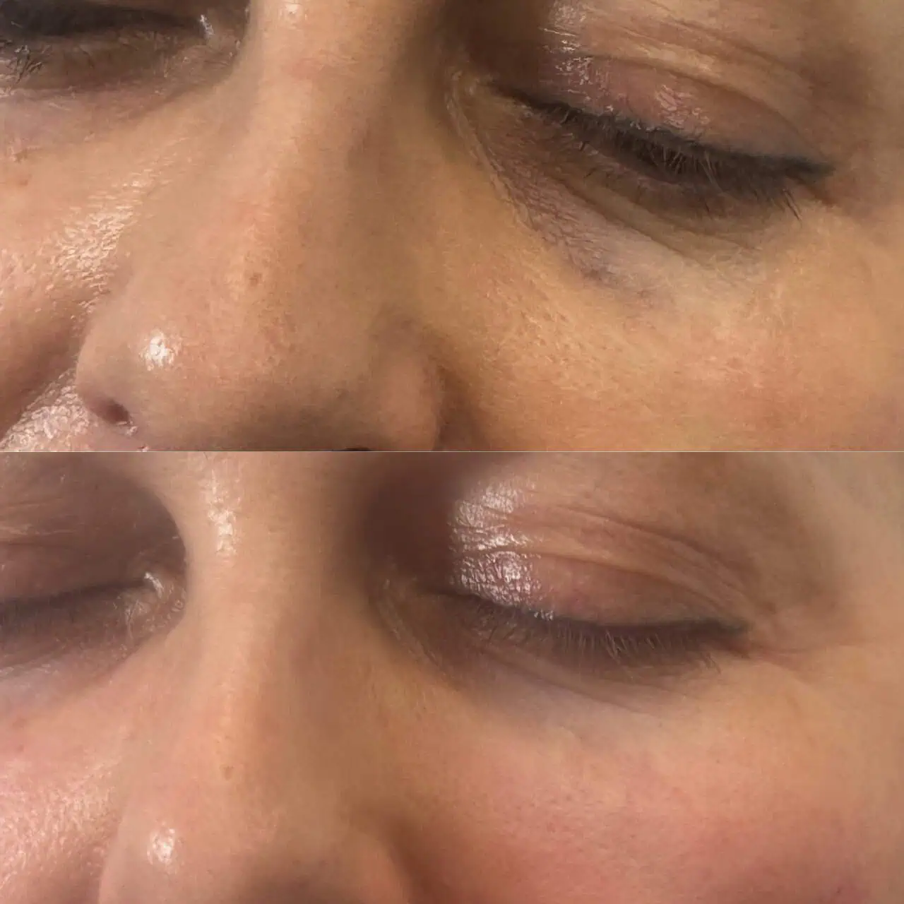 Before After Under eye filler Treatment in San Mateo, CA by Pink Opal Aesthetics