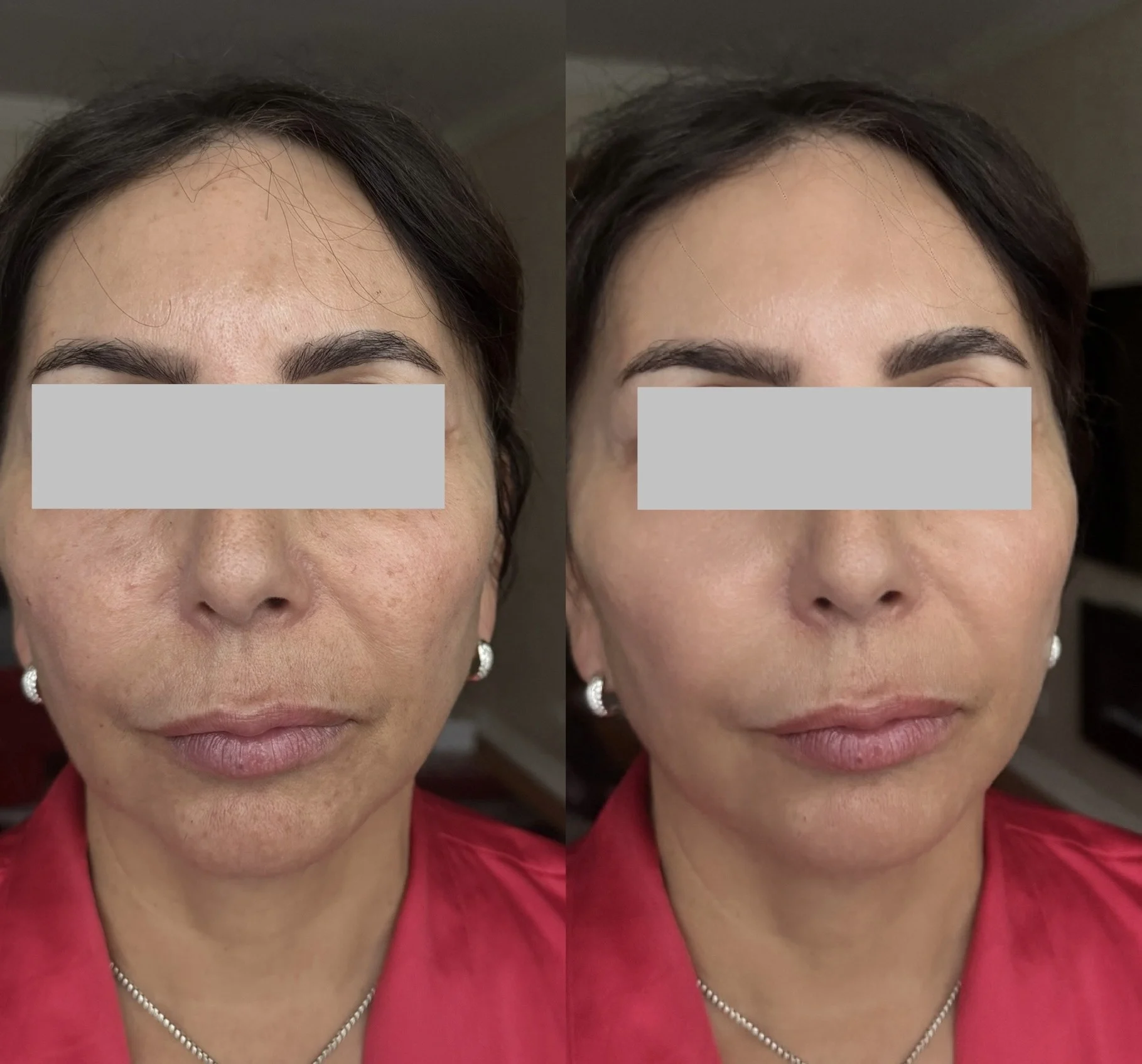 Chemical Peel