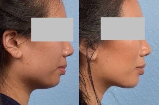 Chin filler 1 by Pink Opal Aesthetics in San Mateo, CA