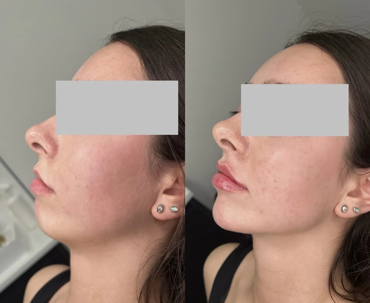 Chin filler Treatment by Pink Opal Aesthetics in San Mateo, CA