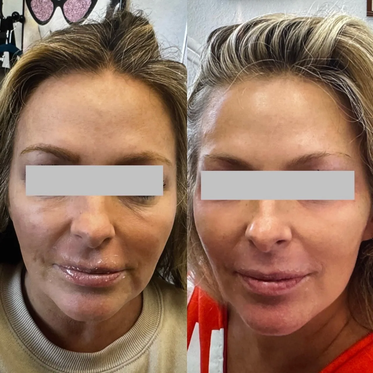 Facial Balancing 1 by Pink Opal Aesthetics in San Mateo, CA