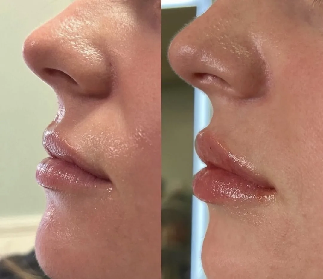 Before After Lip filler 1 by Pink Opal Aesthetics in San Mateo, CA