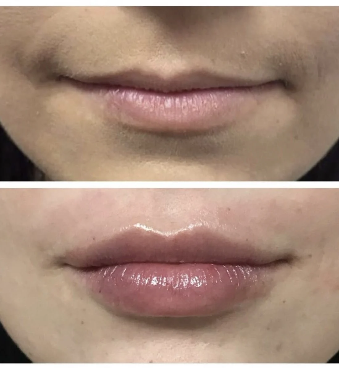 Lip filler Treatment by Pink Opal Aesthetics in San Mateo, CA