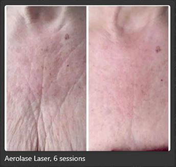 Aerolase Laser Treatment at pink Opal Aesthetics
