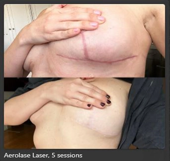 Aerolase Laser at pink Opal Aesthetics