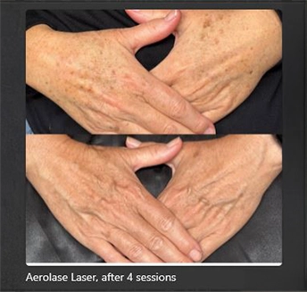 Aerolase Laser for hand at pink Opal Aesthetics