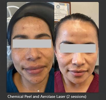 Aerolase Laser for Face at pink Opal Aesthetics