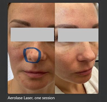 Aerolase Laser 6 at pink Opal Aesthetics