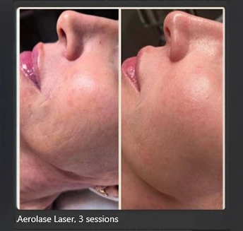 Aerolase Laser_7 at pink Opal Aesthetics
