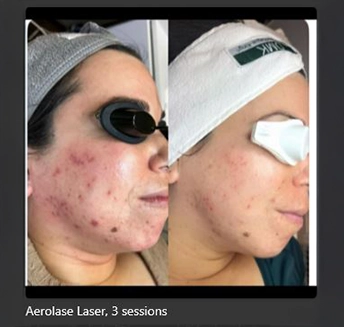 Aerolase Laser_8 at pink Opal Aesthetics