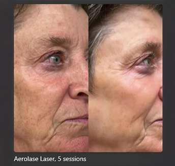 Aerolase Laser_9 at pink Opal Aesthetics