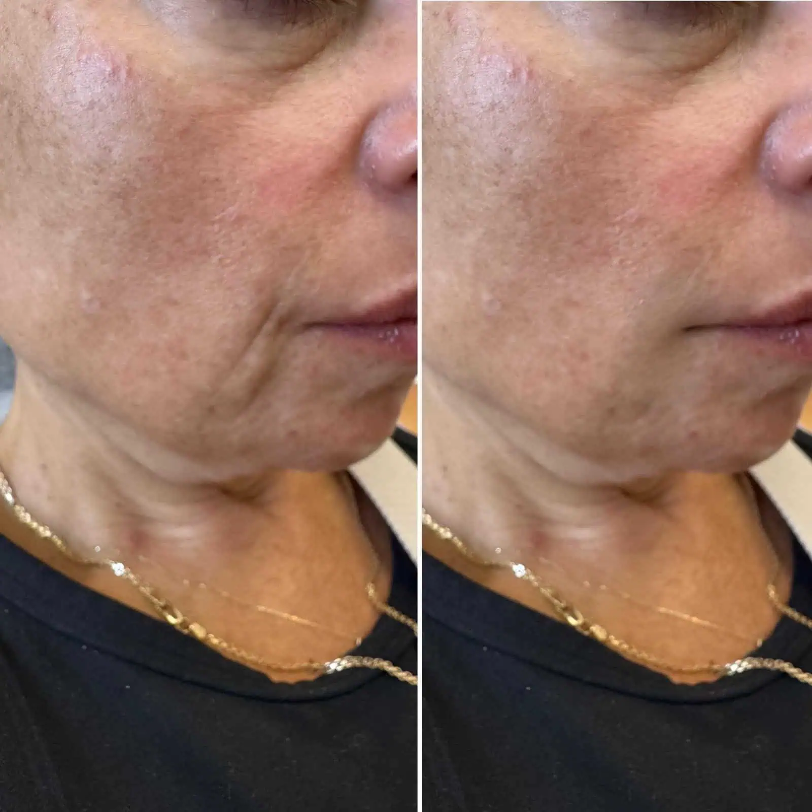 Dermal Fillers Treatment in San Mateo CA