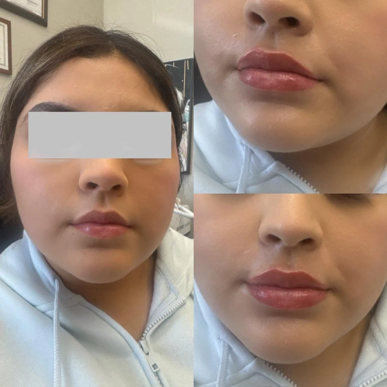 Lip fillers - a Treatment in San Mateo CA
