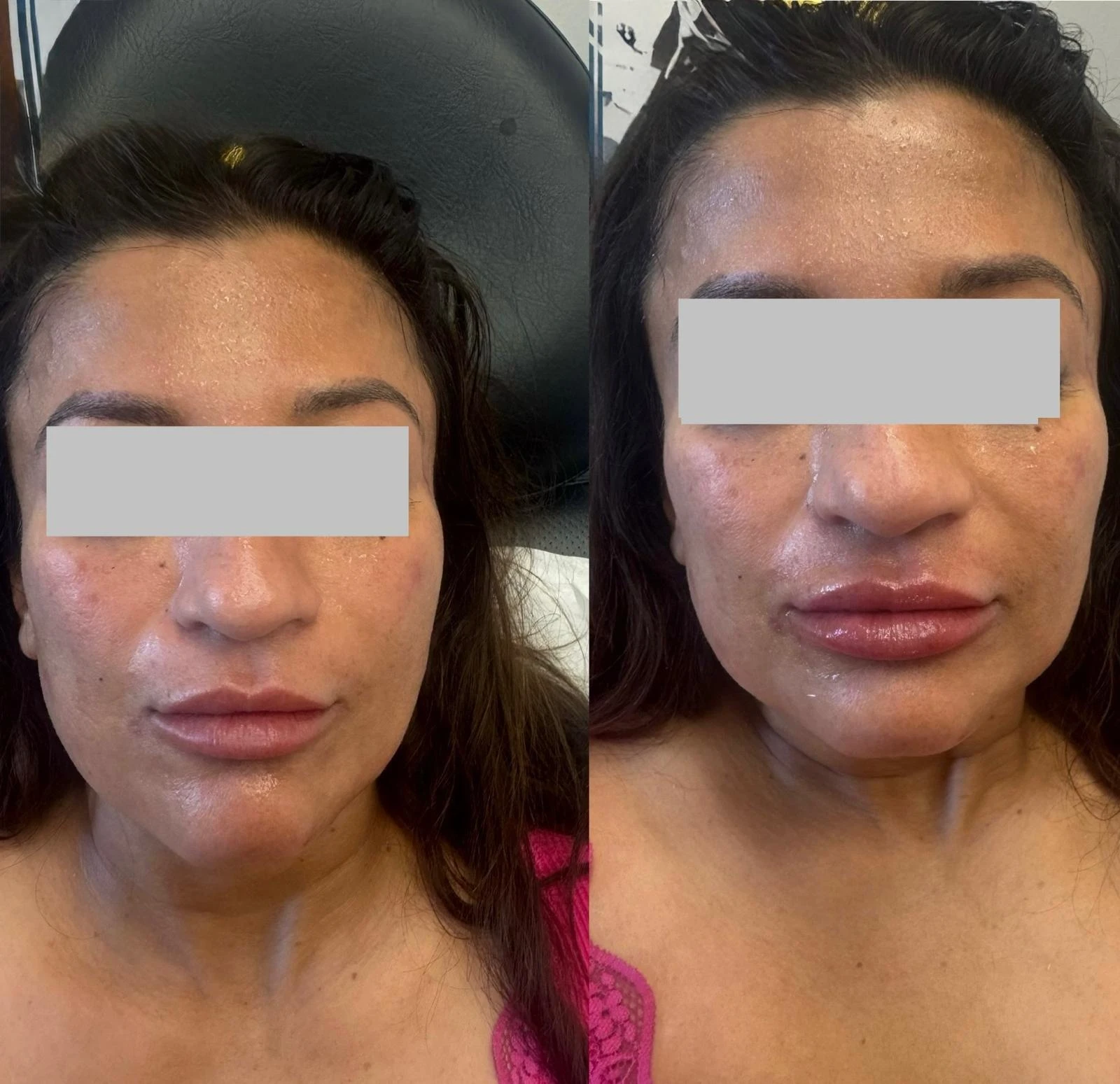 Lip fillers - b Treatment in San Mateo CA