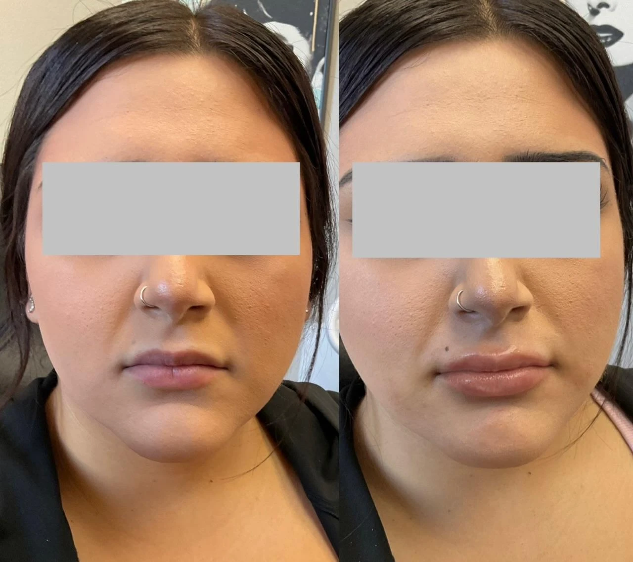 Lip fillers - c Treatment in San Mateo CA