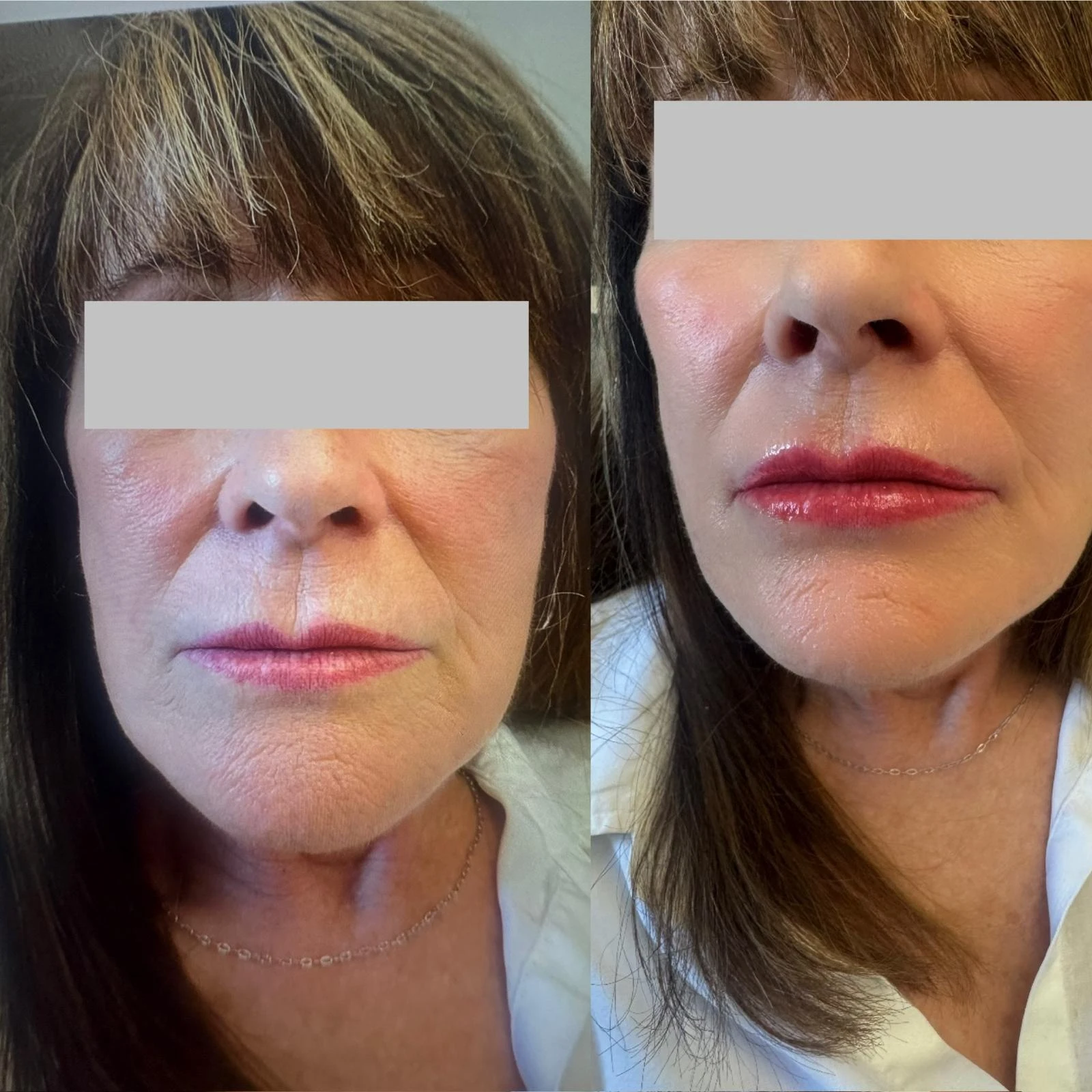 Lip fillers - d Treatment in San Mateo CA