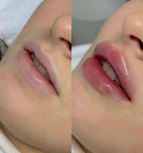 Lip fillers - e Treatment in San Mateo CA