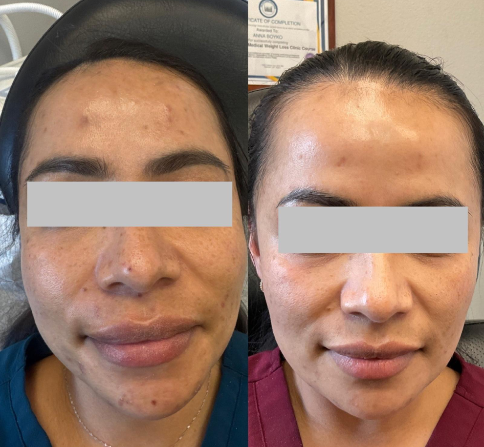 Pink-Opal-Aesthetics-chemical-peels-Before-After-A-in-San-Mateo-CA