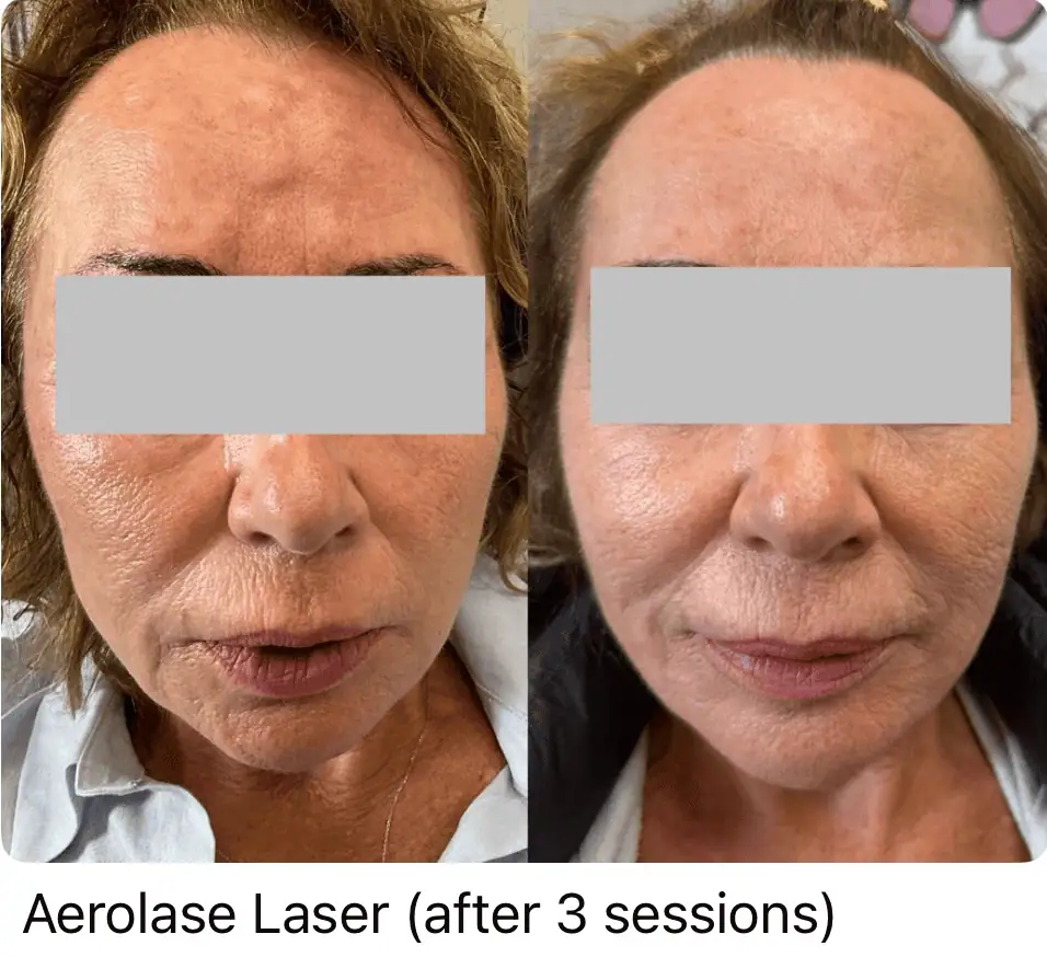 Aerolase Laser before and after 1