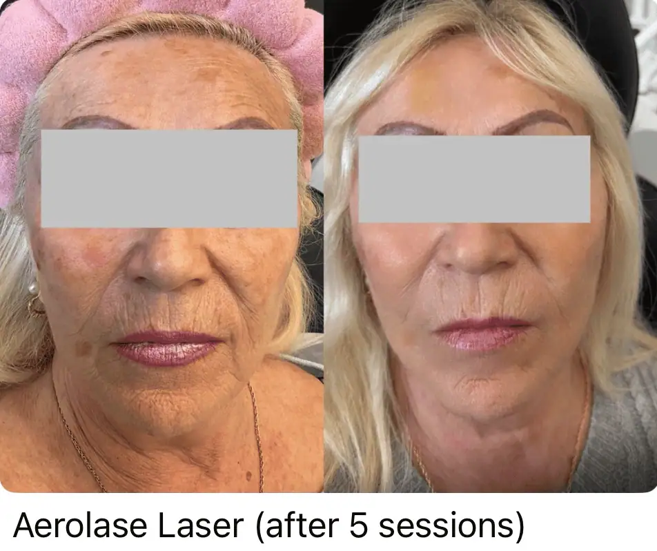 Aerolase Laser before and after 2