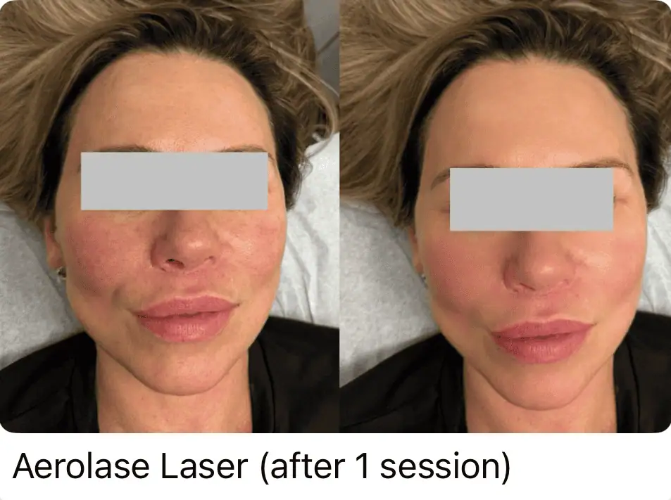 Aerolase Laser before and after 3
