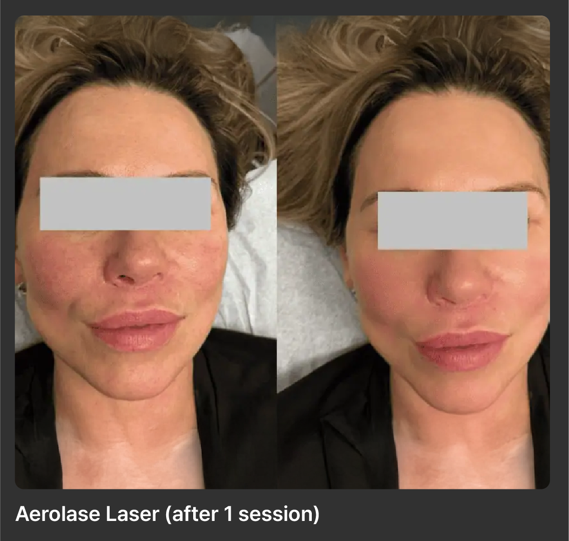 Aerolase-Neo-Laser-Before-After-10