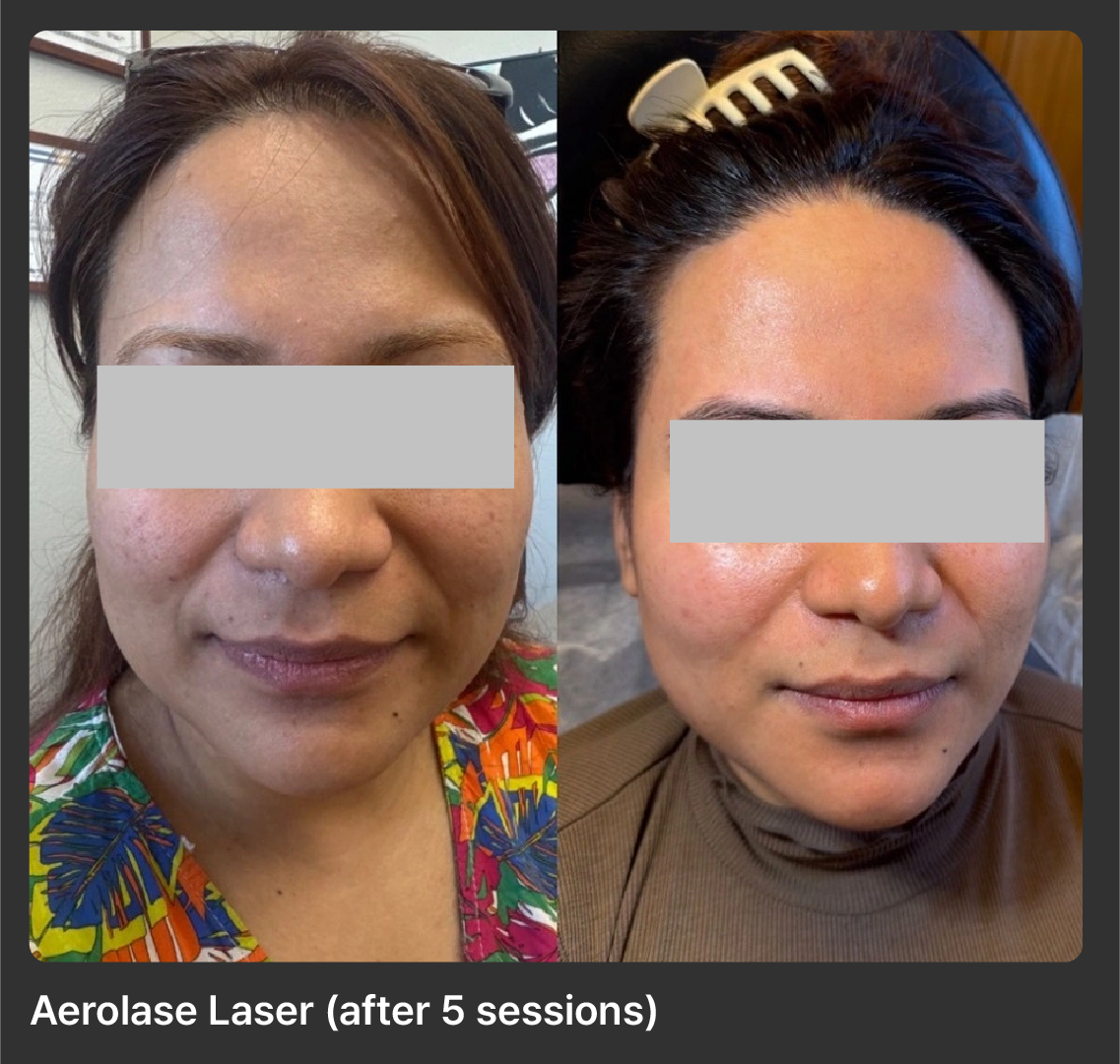 Aerolase-Neo-Laser-Before-After-13