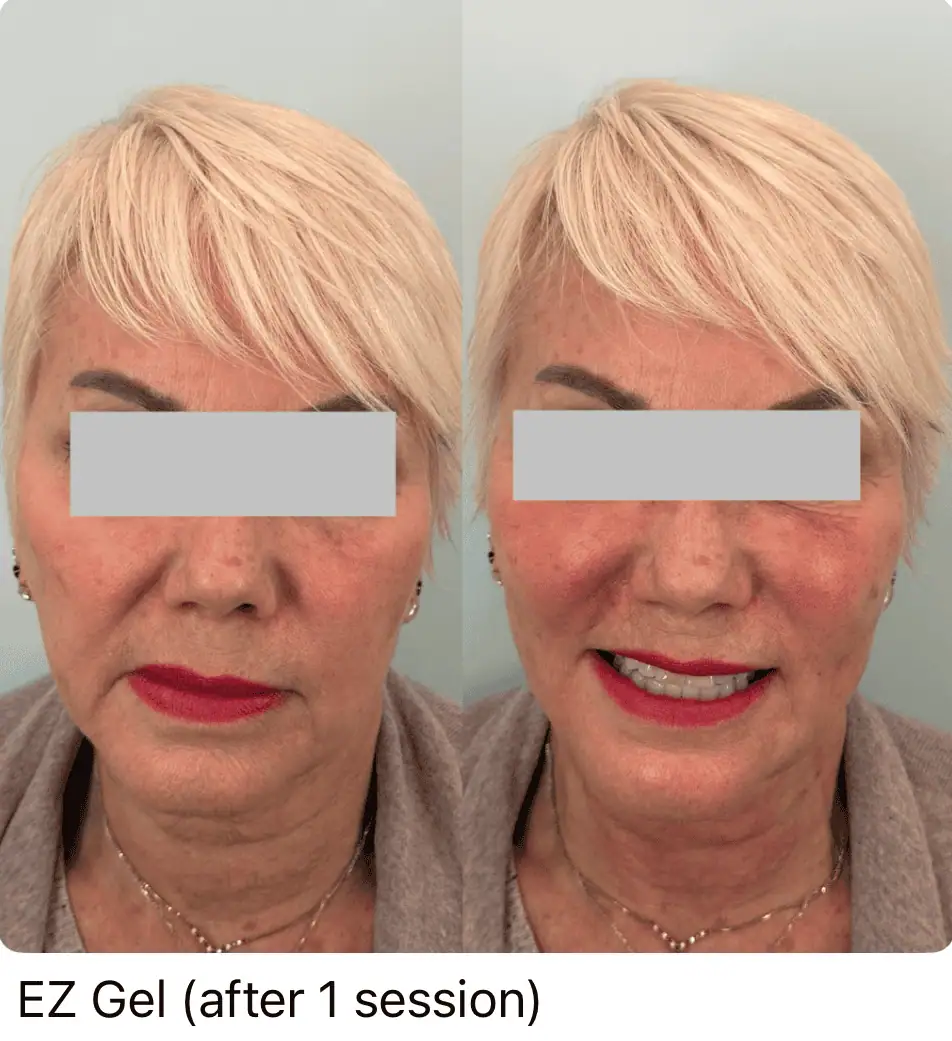 EZ Gel Before and After