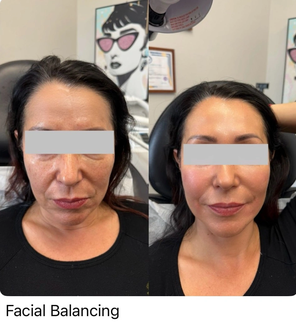 Facial Balancing