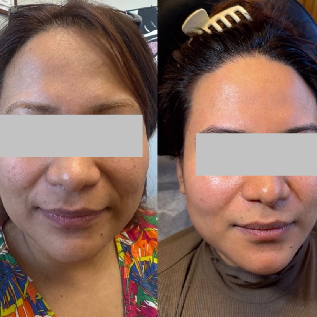 Aerolase® Neo Laser 1