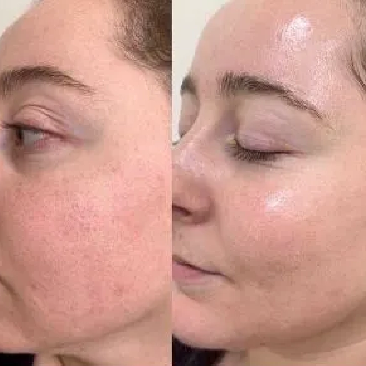 Aerolase® Neo Laser 10