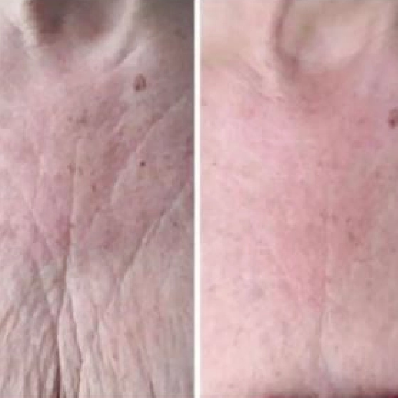 Aerolase® Neo Laser 12