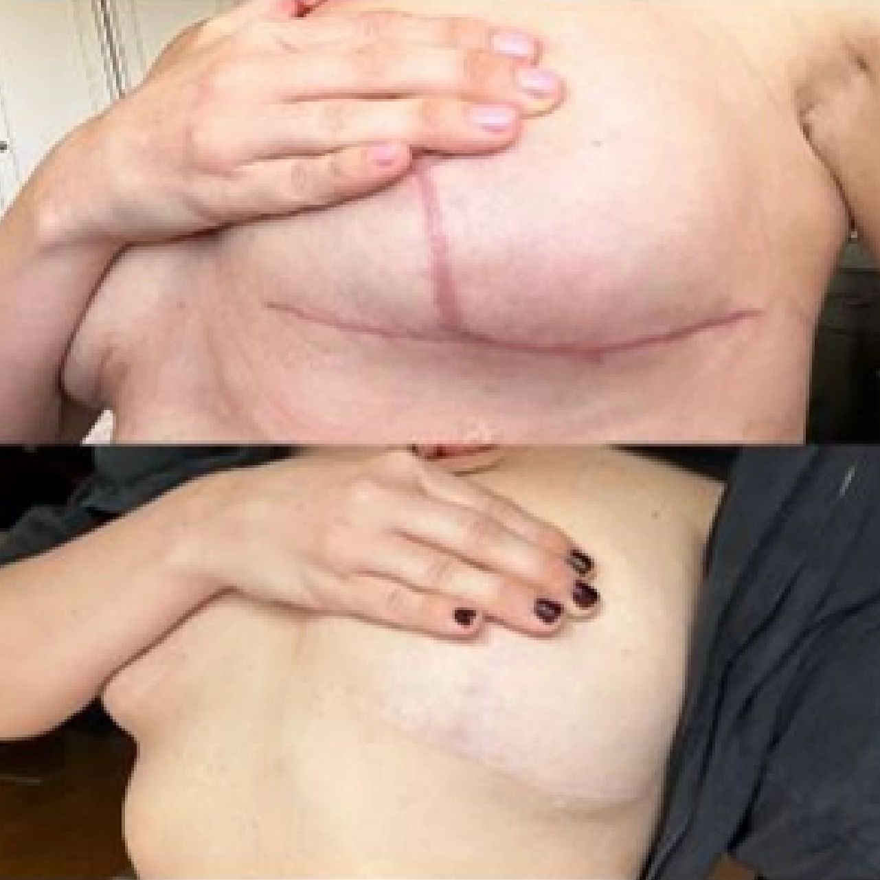 Aerolase® Neo Laser 13