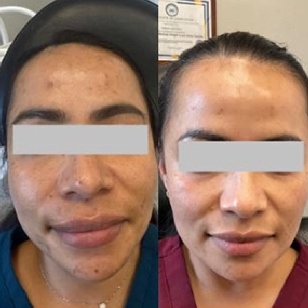 Aerolase® Neo Laser 15