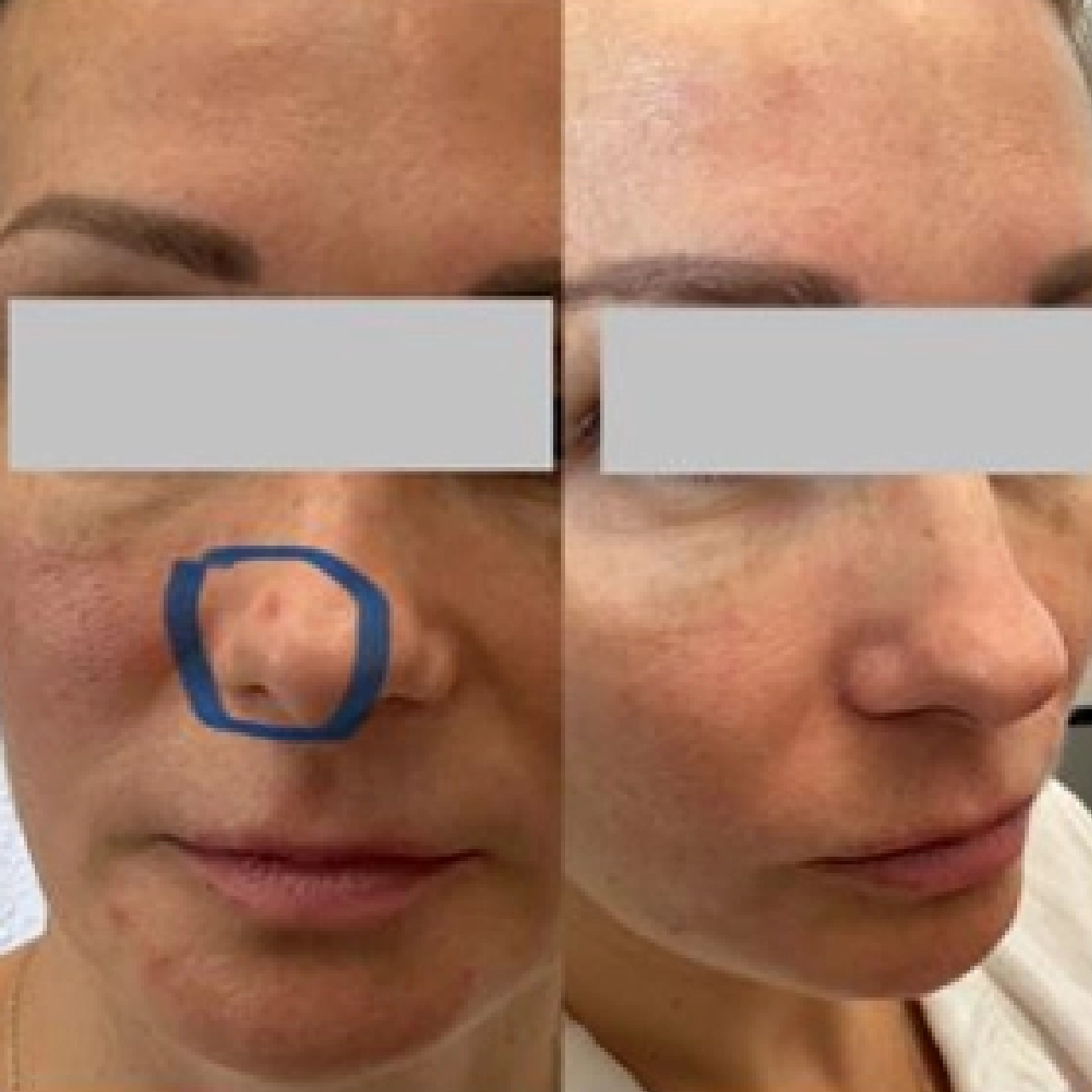 Aerolase® Neo Laser 16